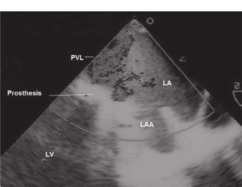 Intraoperative Transesophageal Echo La Left Atrium Laa Left Atrial Download Scientific