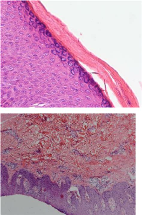 H And E Stained Slide Showed Hyperkeratosis Parakeratosis Of