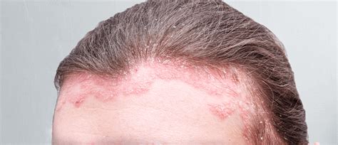 Treatment for Scalp Psoriasis: Best OTC & 9 Natural Ways to A Healthy ...