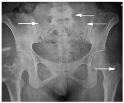 Sacroiliac Joint X Ray