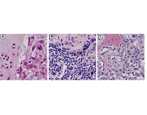 Chondrosarcoma Histology Quiz