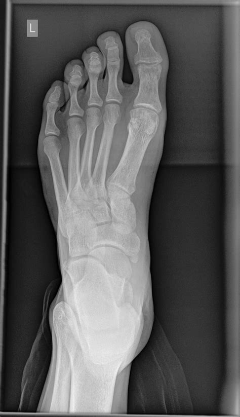 Lateral Hallux Sesamoid Avascular Necrosis Image Radiopaedia Org