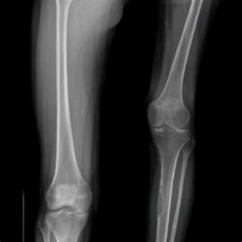 Preoperative Plain Radiograph Of The Lower Limb Showing Severe Limb