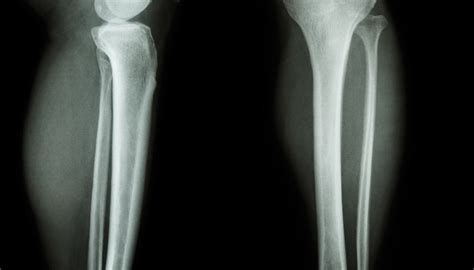 What Are the Structural Parts of the Long Bones in the Body? | Sciencing