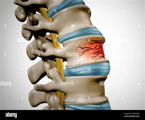 Fractura de columna vertebral traumática y lesión vertebral concepto