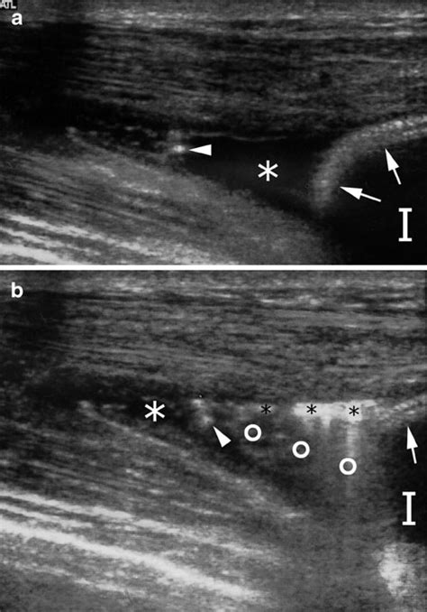 A 24 Year Old Woman With Capsular Contracture In Her Augmented Right Download Scientific