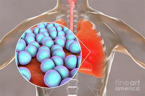 Pneumonia Caused By Streptococcus Pneumoniae Bacteria By Kateryna