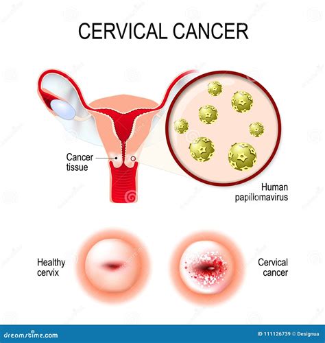 Cervical Cancer Symptoms Infographic Vector Illustration