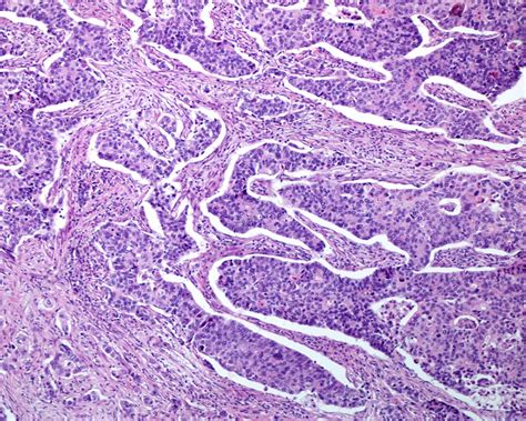 Gastric Adenocarcinoma Light Micrograph Stock Image C