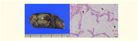 Figure 1 From Surgical Case Report Colloid Adenocarcinoma Of The Lung Semantic Scholar