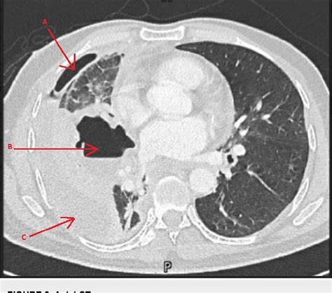 PDF A Case Of Necrotizing Pneumonia Complicated By Hydropneumothorax