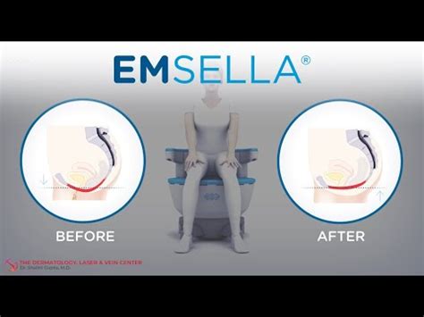 EMSELLA Incontinence Intimacy Treatment At The Dermatology Laser