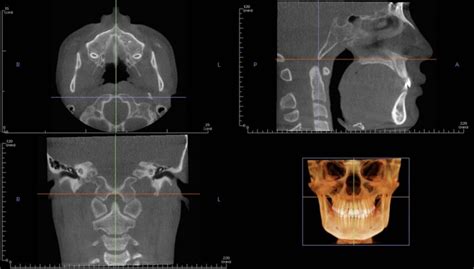 Mid Sagittal Cbct Evaluation Of Spheno Occipital Synchondrosis With The Download Scientific