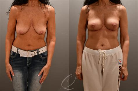 Breast Augmentation With Fat Transfer Before After Photos Patient