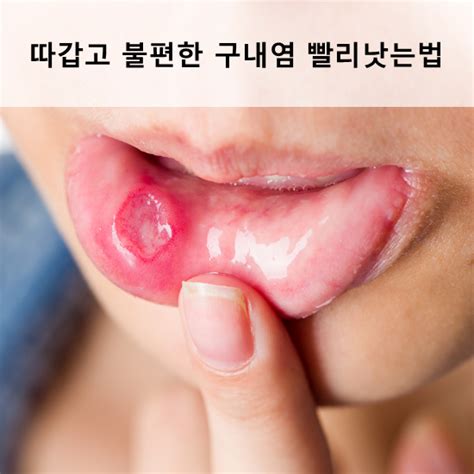 따갑고 불편한 구내염 빨리낫는법 네이버 블로그