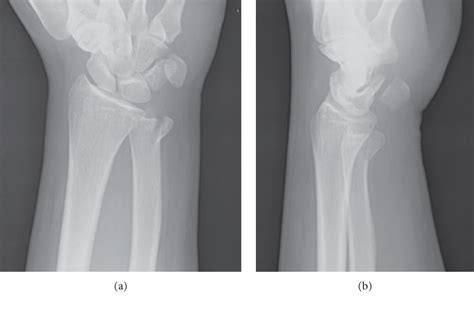 Figure 1 from Bone Resection for Isolated Ulnar Head Fracture | Semantic Scholar