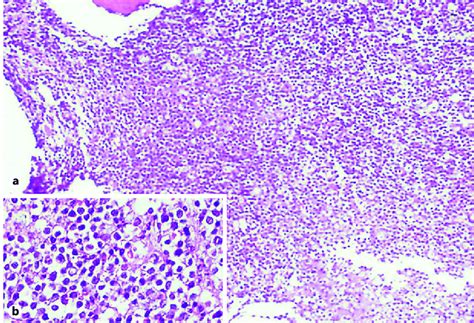 Bone marrow biopsy showing (a) densely packed medullary spaces occupied... | Download Scientific ...