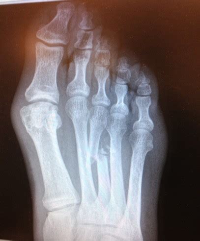 Fractures - Greater Houston Foot & Ankle Specialists