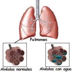 Qu Tan Malo Es Tener Agua En Los Pulmones Es Mortal Es Mortal