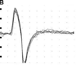 Normal recordings of biceps brachii T-reflex (a case 3; b case 5) and... | Download Scientific ...