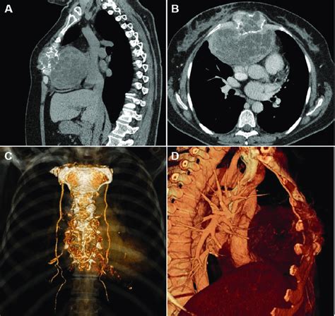 A Sagittal And B Axial Chest Ct Images With C D D