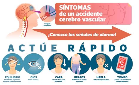 Derrame Cerebral Reconozca Las Señales Y Actúe Rápido