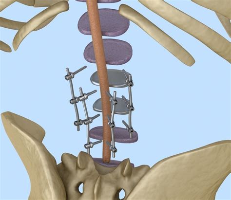 Spinal Fixation System Titanium Bracket 3d Model Cgtrader