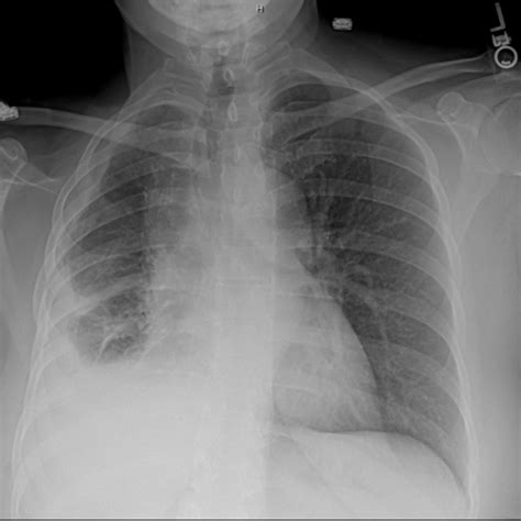 Can Asbestosis Cause Lung Cancer