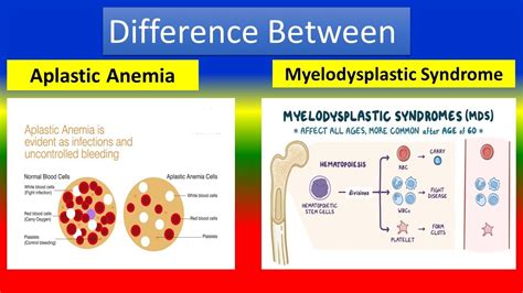 Difference Between Aplastic Anemia And Myelodysplastic Syndrome Youtube