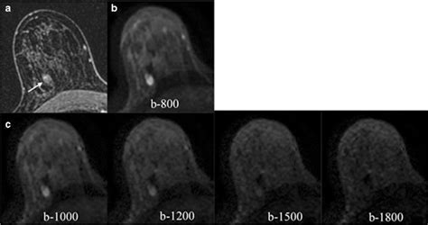 Axial Contrast Enhanced A Acquired Dwi B And Synthetic Dwi C