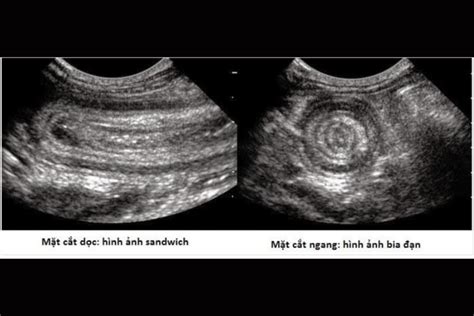 Cách chăm sóc dinh dưỡng cho hình ảnh siêu âm tắc ruột ở thai nhi