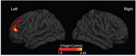 Differences In Cortical Thickn [image] Eurekalert Science News Releases