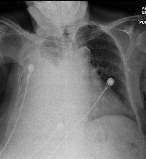 Pulmonary Edema Sputum