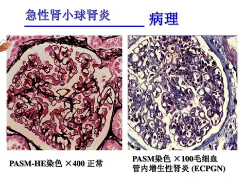 小儿急性肾小球肾炎word文档在线阅读与下载无忧文档