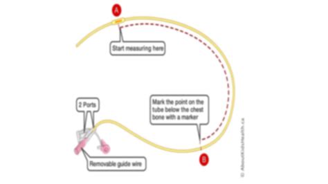 Solution Nasogastric Tube Insertion And Feeding Presentation Studypool