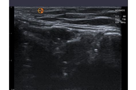 Musculoskeletal Ultrasound Msk Echonous