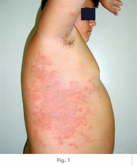 Figure From Cutaneous Larva Migrans Semantic Scholar