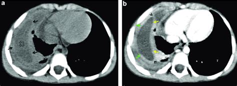 Tomodensitométrie thoracique en coupe axiale en fenêtre médiastinale