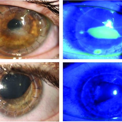 Ocular Surface Findings Following Cenegermin Treatment For Nk On Pk Download Scientific