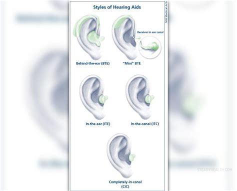 Hearing loss treatment | General center | SteadyHealth.com