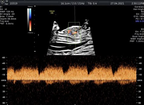 The Incidence Of The Agenesis Of Fetal Ductus Venosus At The