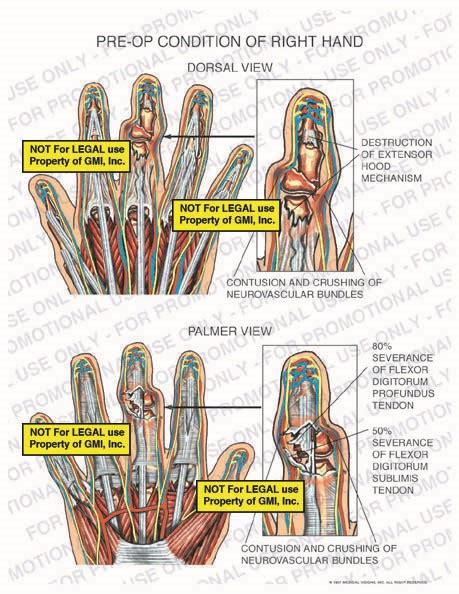 Pre Op Condition Of Right Hand 97197f22b Generic Medical Legal Exhibits A Division Of Mvi