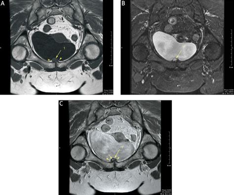 Magnetic Resonance T1 Weighted Image A T2 Stir Image B And