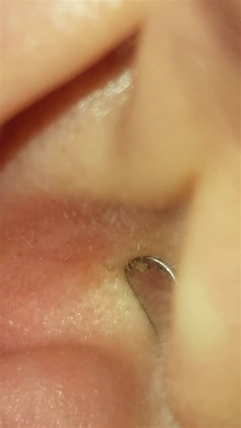 Ear blackhead : r/popping