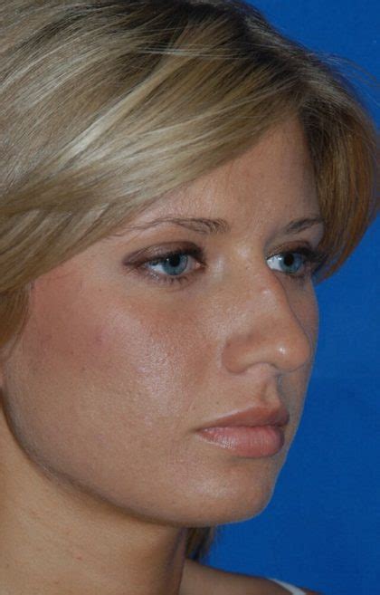 Patient Primary Rhinoplasty Before And After Photos Englewood