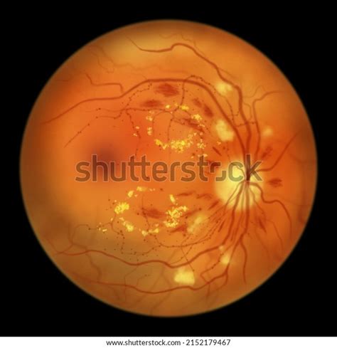 Nonproliferative Diabetic Retinopathy Illustration Showing Microaneurysms Stock Illustration