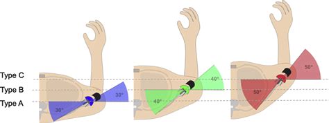 Schema Of Reverse Total Shoulder Arthroplasty Implantation In