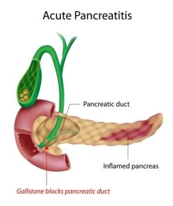 Pancreas Disease | Jackson Siegelbaum Gastroenterology