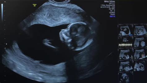 Ultrasound of Pregnant Woman, Stock Footage | VideoHive