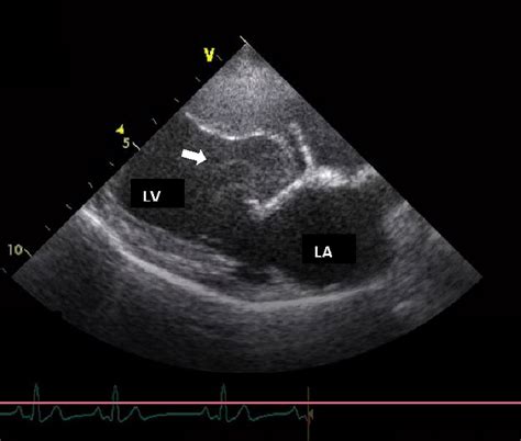 Right Parasternal Long Axis View Of Left Atrium La And Ventricle Lv Download Scientific